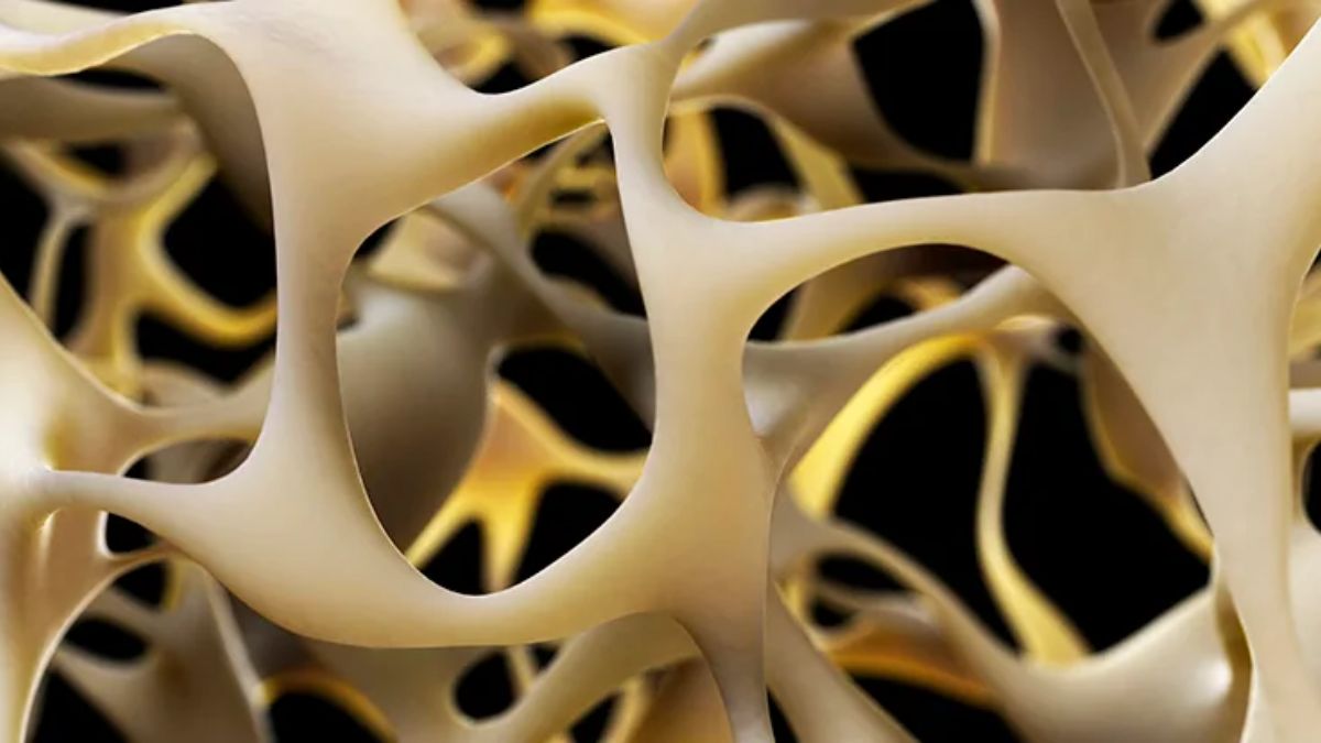 Osteoporosis